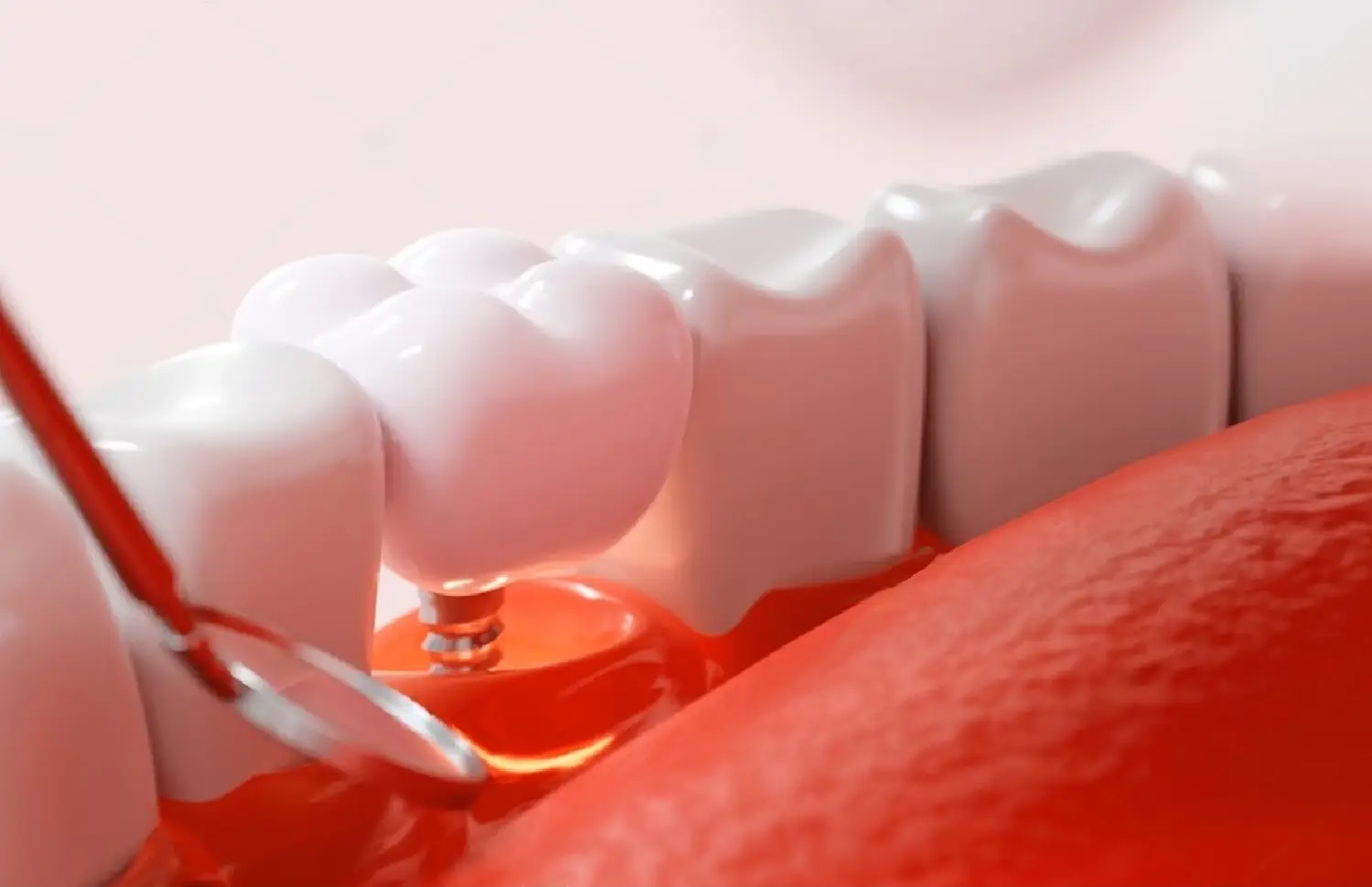 ¿Cuánto duran los implantes dentales?