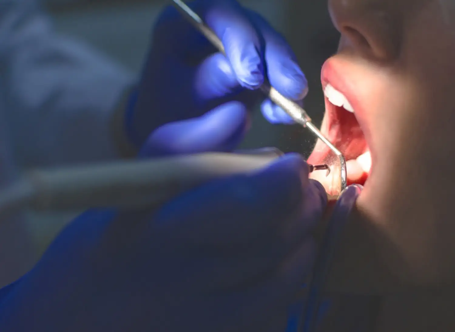 What is dental curettage?