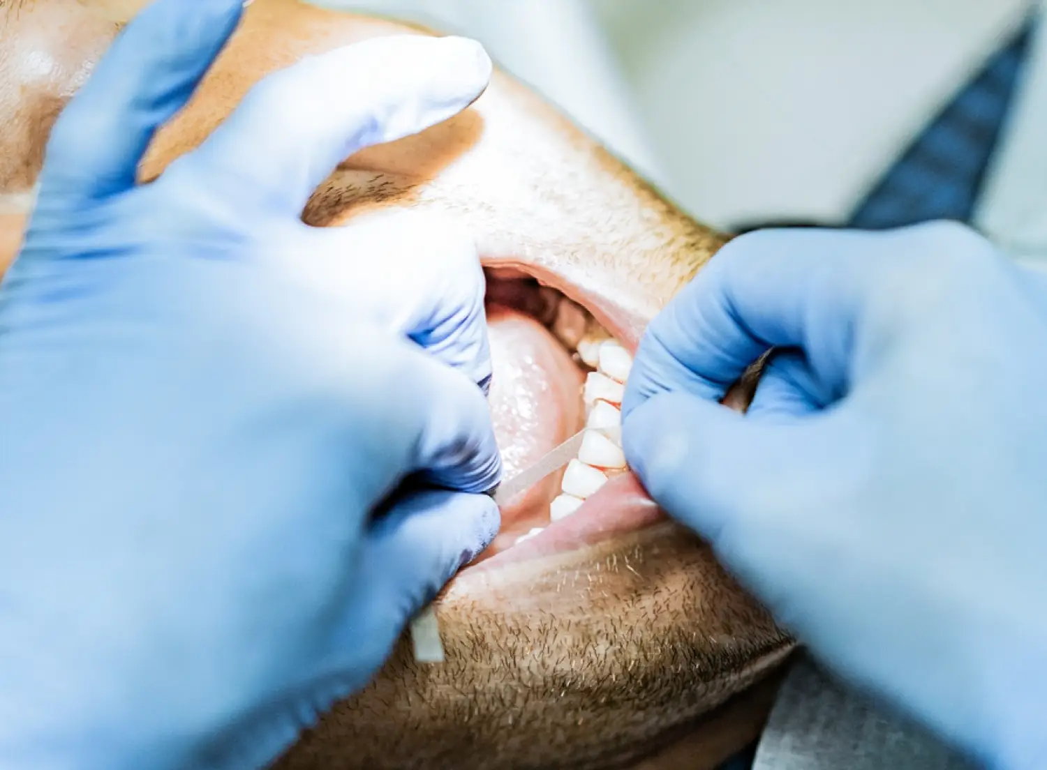 What is dental stripping or IPR?