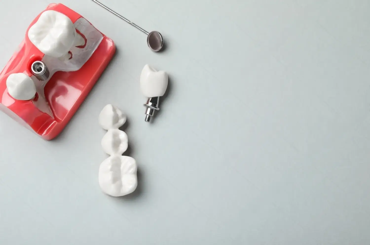Dental bridge or implant: Which is better?