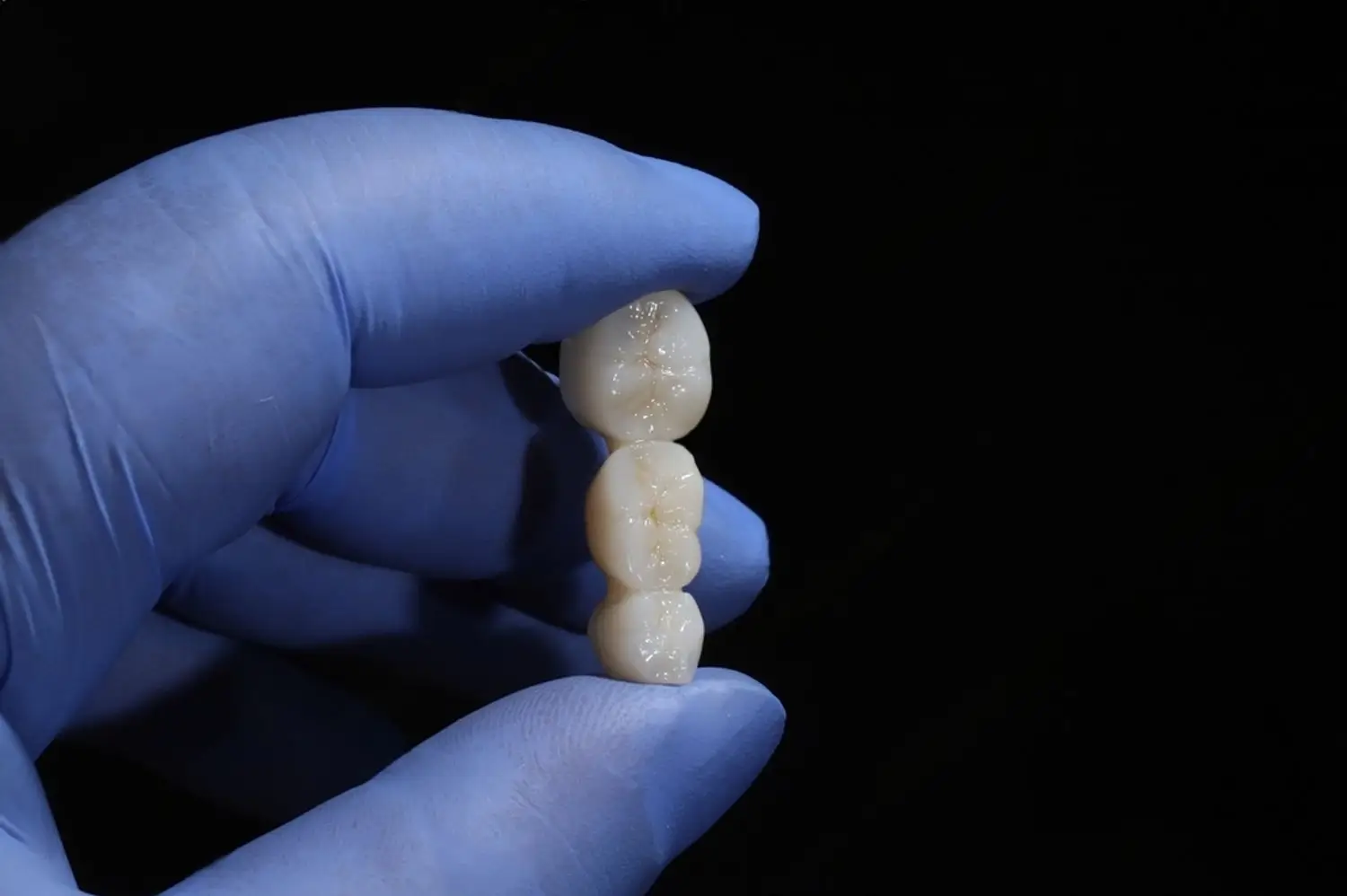 ¿Qué es un puente dental?