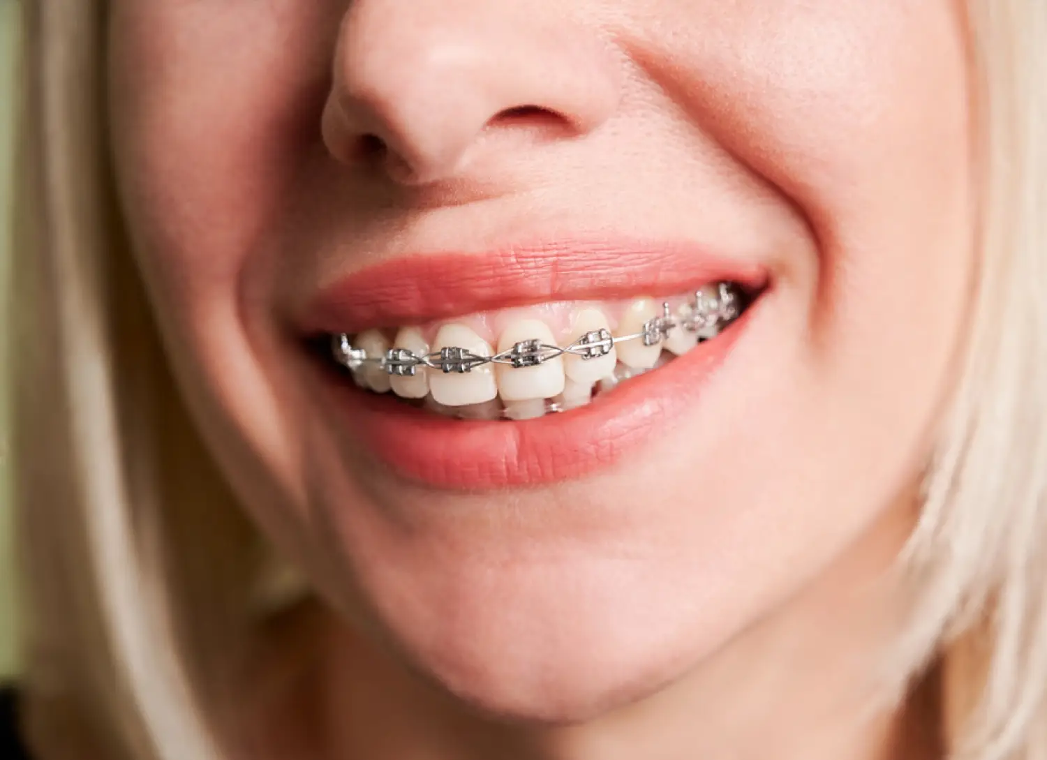 ¿Duele más la ortodoncia con brackets o la invisible?