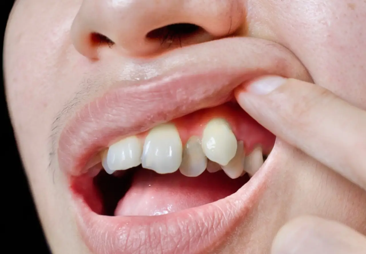 Crossbite, Open Bite, or Deep Bite: How Does Orthodontics Correct Them in Palma de Mallorca?