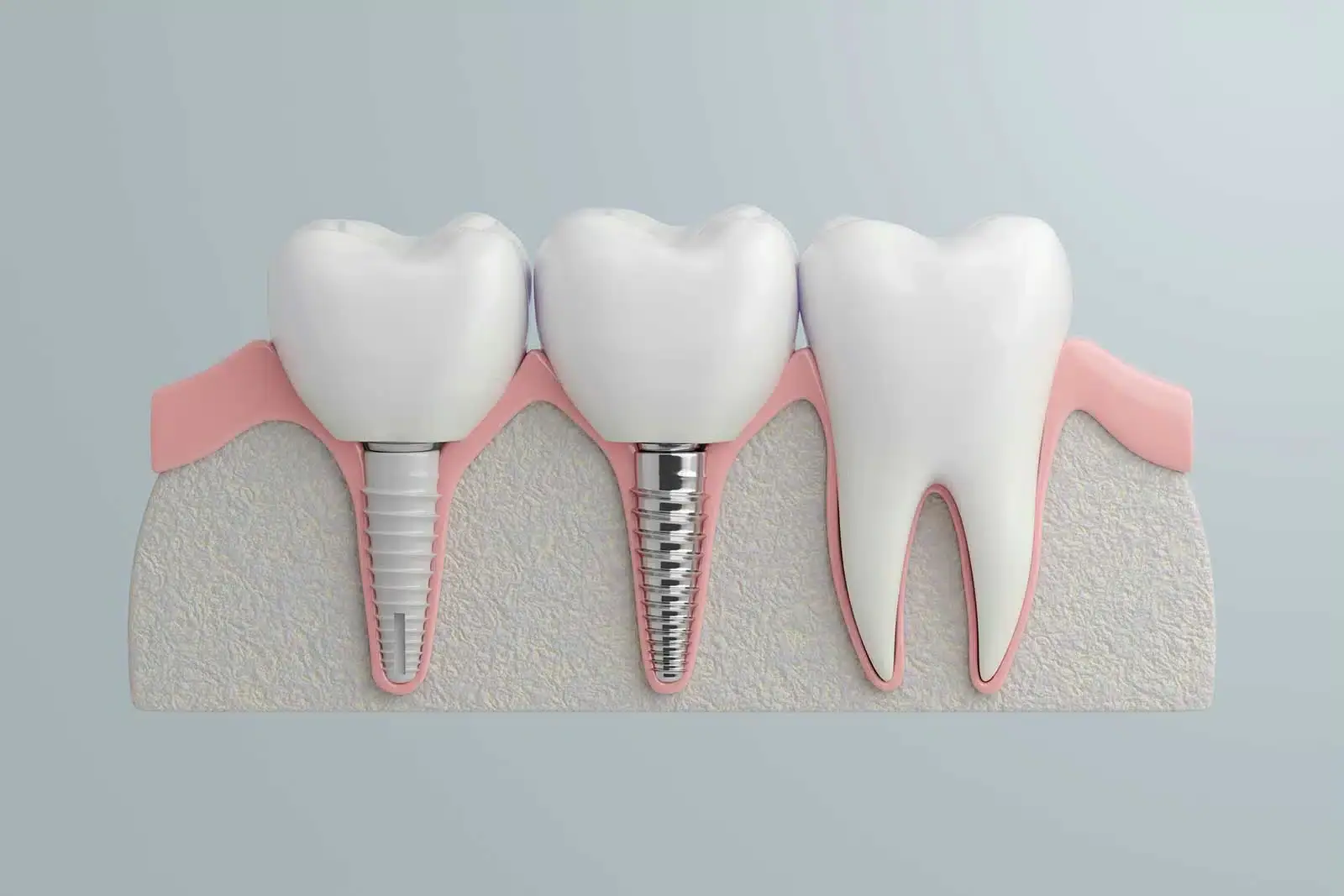 What is the best type of dental implant?
