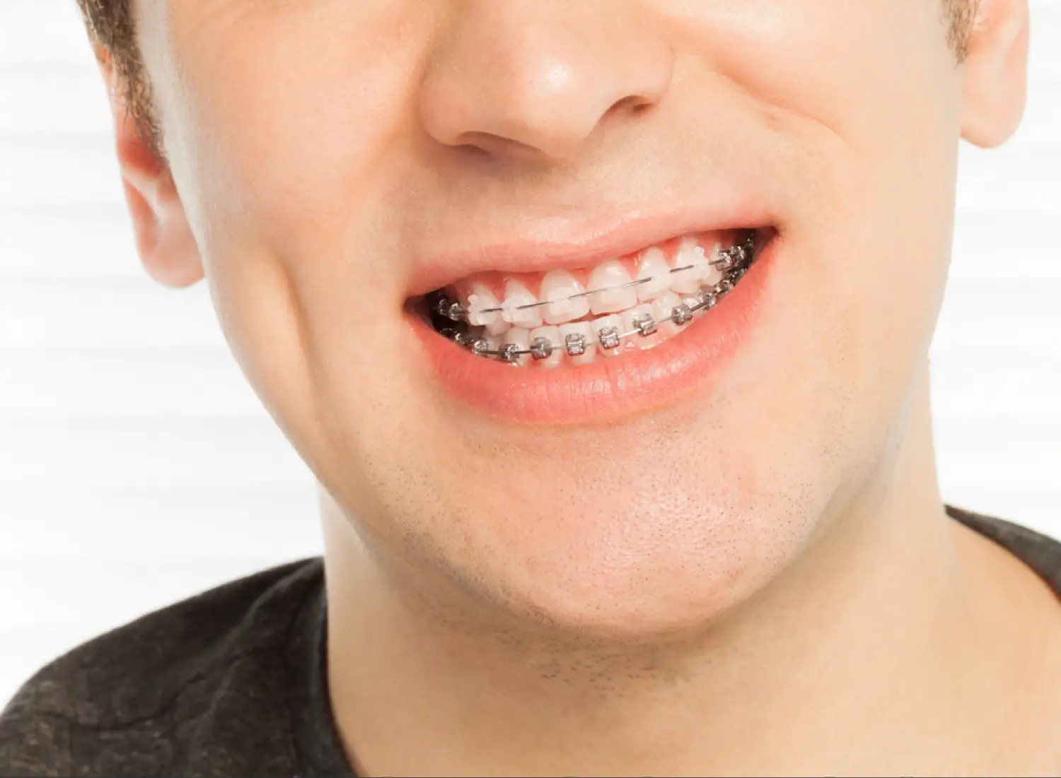 ¿Brackets metálicos o estéticos? ¿Cuáles son mejores?