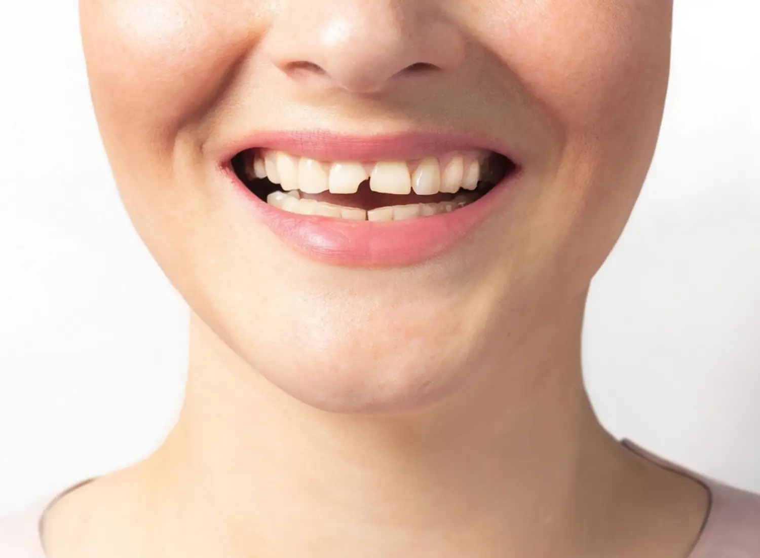 What to Do If You Break a Tooth in Mallorca: Tips and Treatments