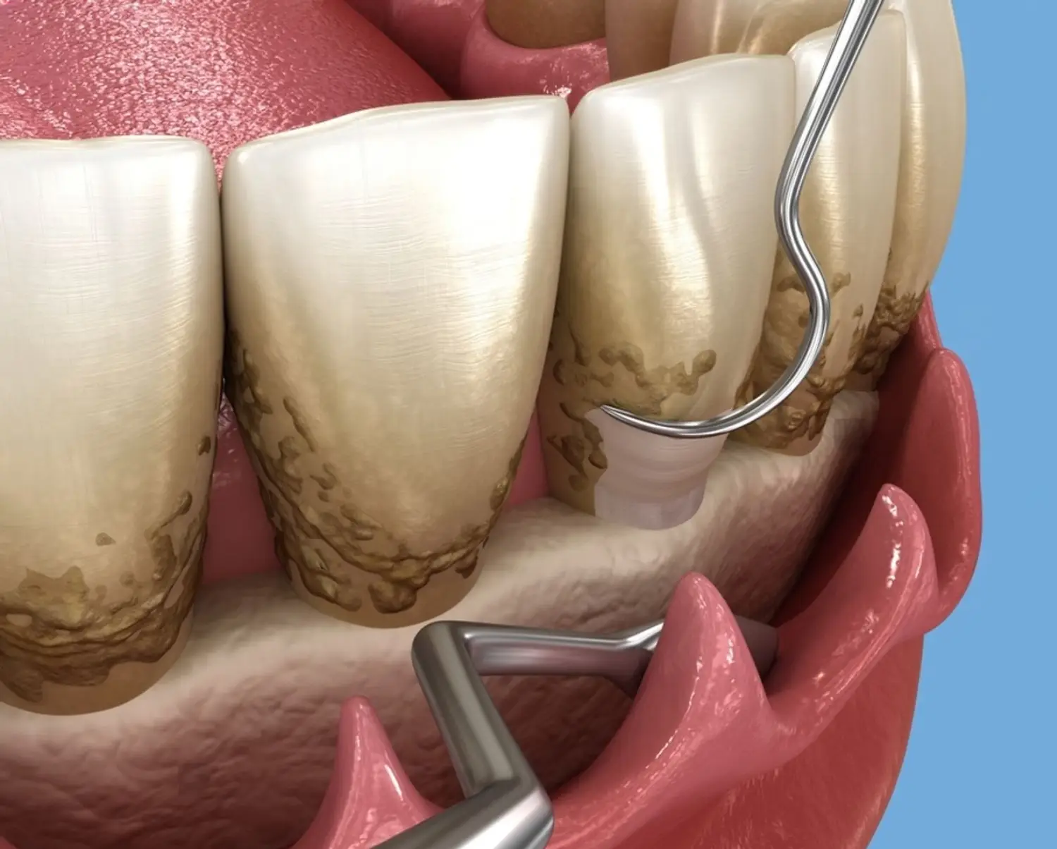 What happens to your teeth after a deep cleaning (curettage)?