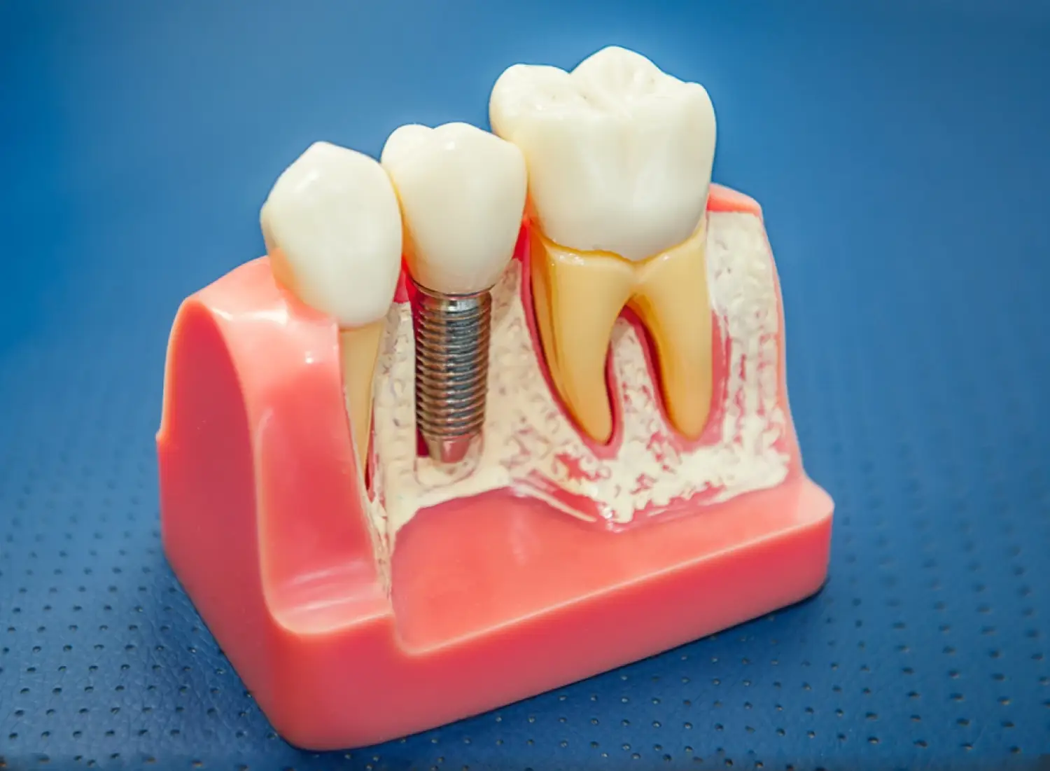 What to do if your dental implant crown breaks?