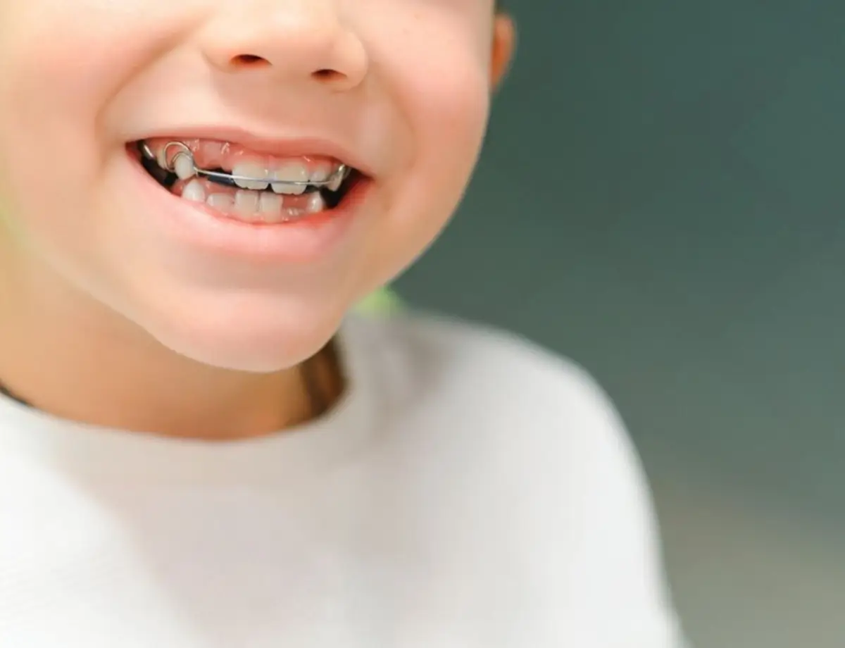 When to Start Orthodontics for Children?