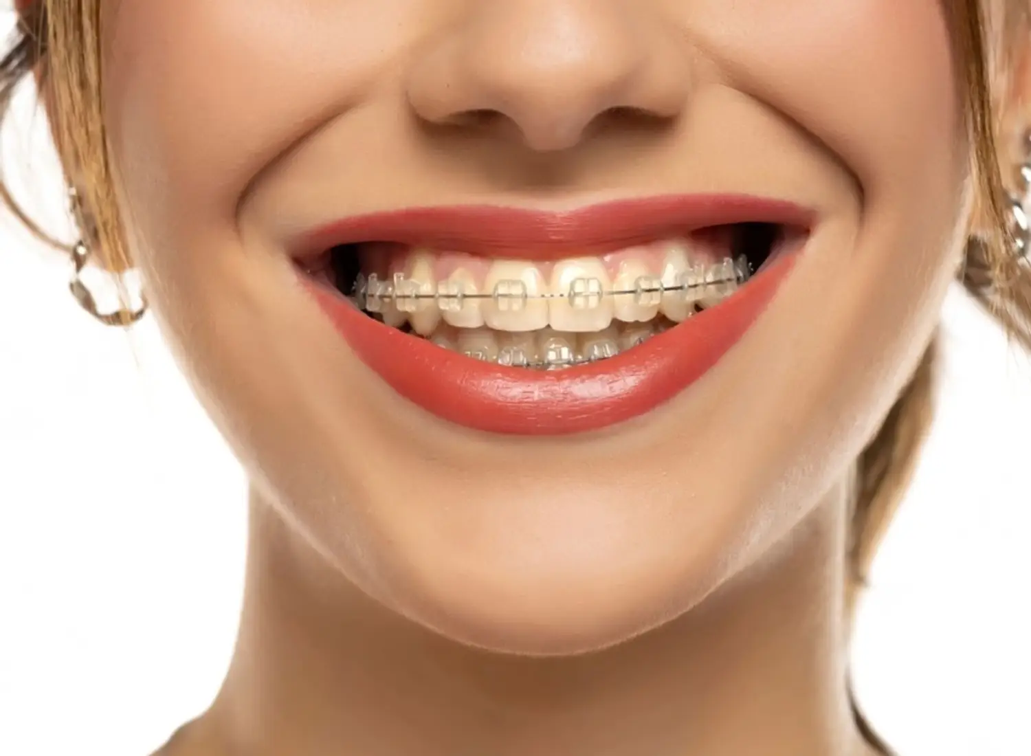 ¿Qué brackets son mejores: los metálicos o los estéticos?