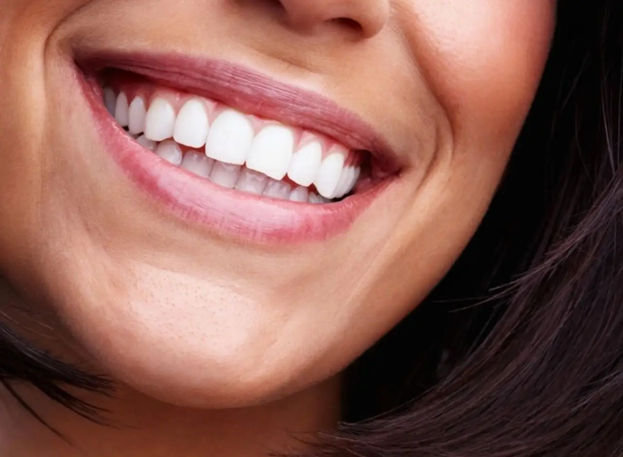 Disadvantages of dental veneers