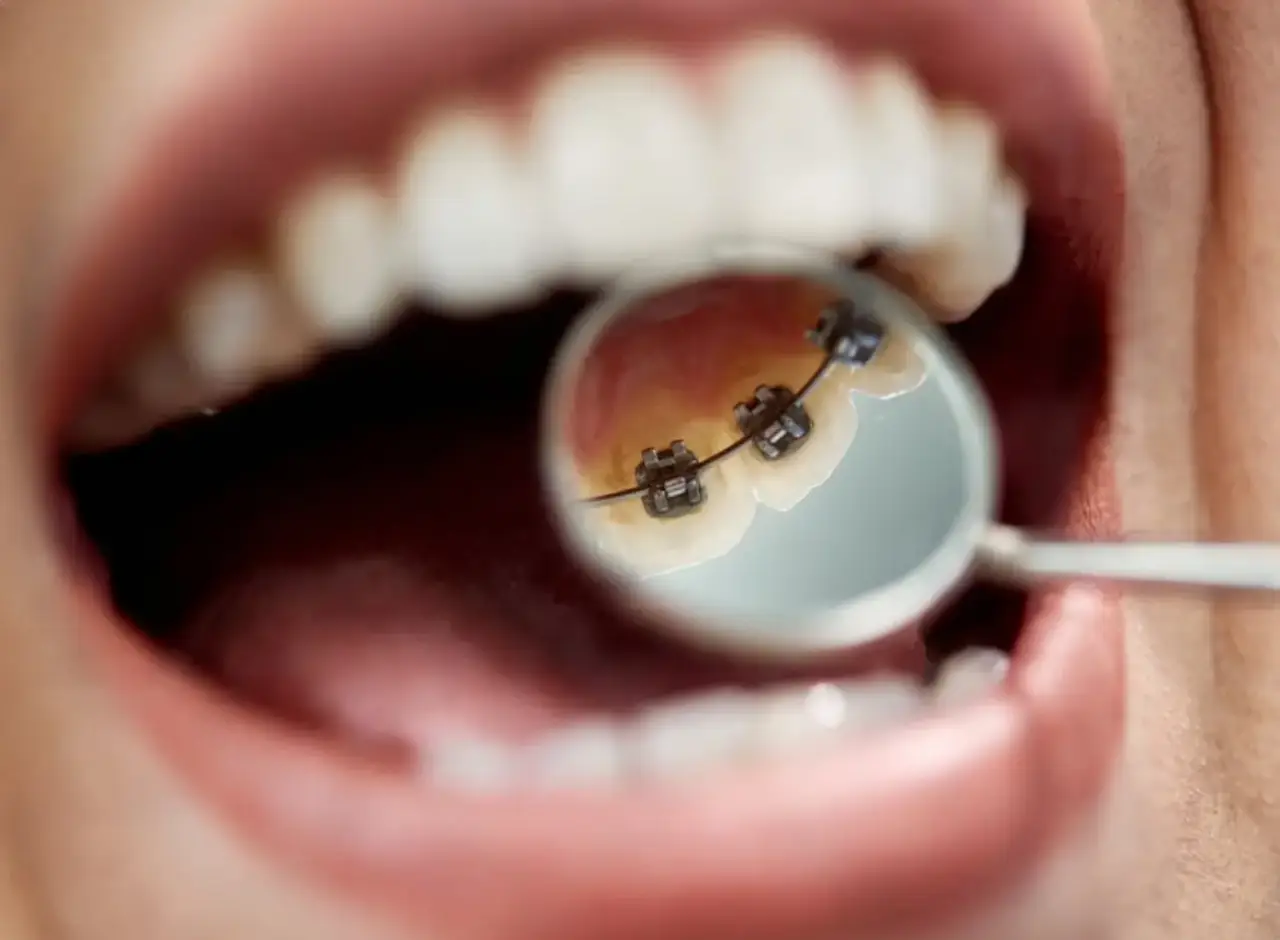 Lingual Orthodontics: Problems, Advantages, and Comparison