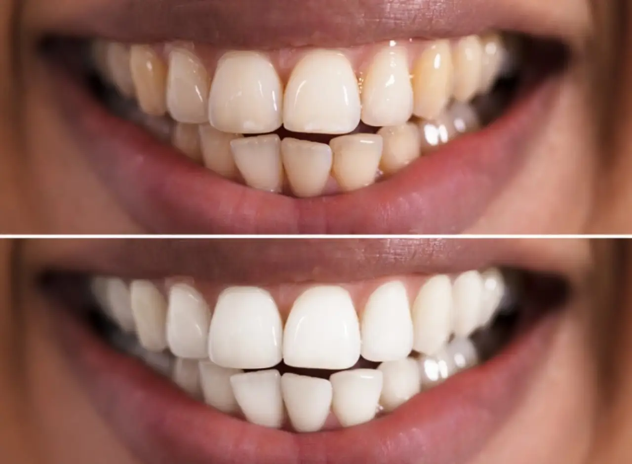 ¿Cuál es el blanqueamiento dental más efectivo?