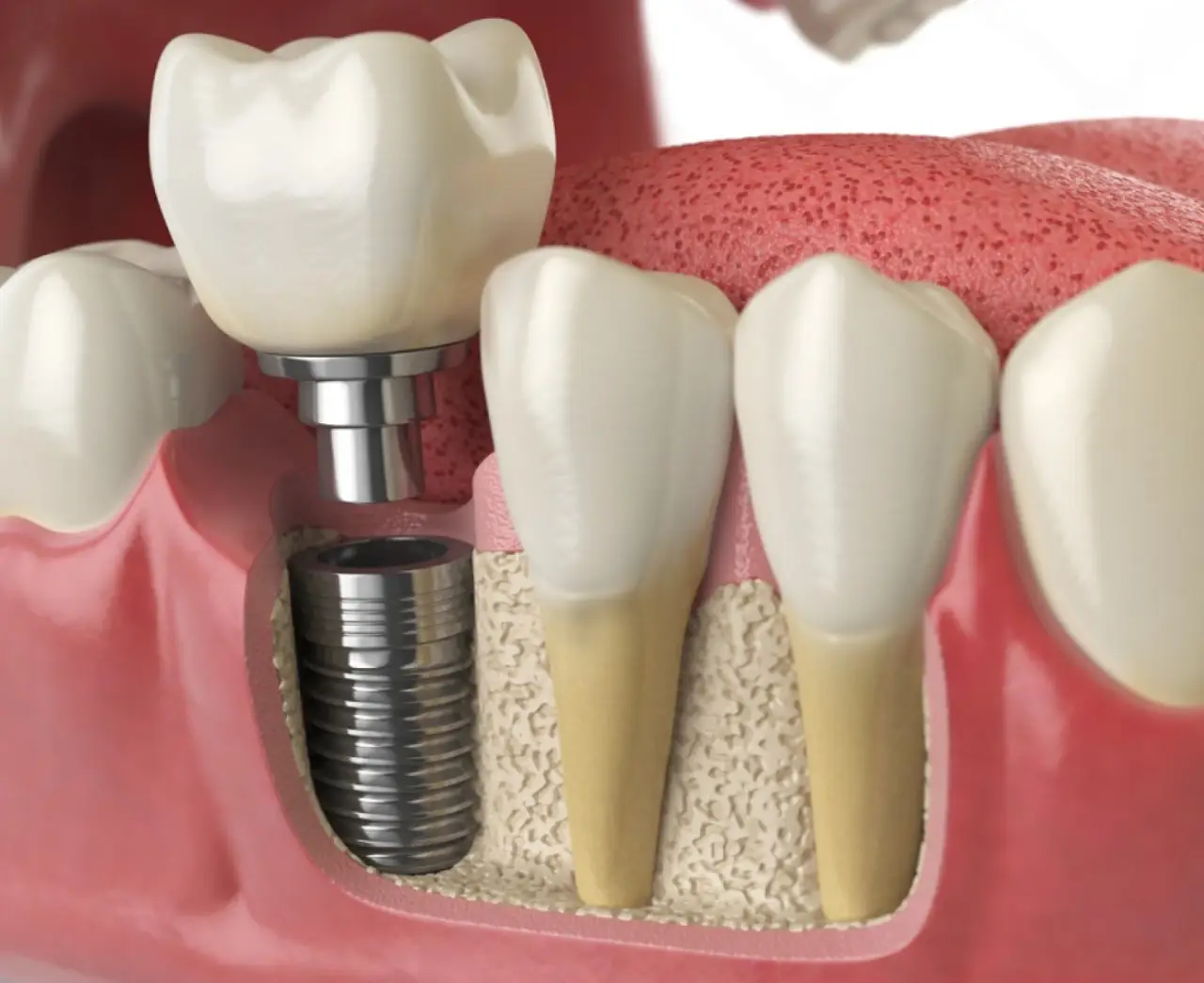 How many days of rest after a dental implant?
