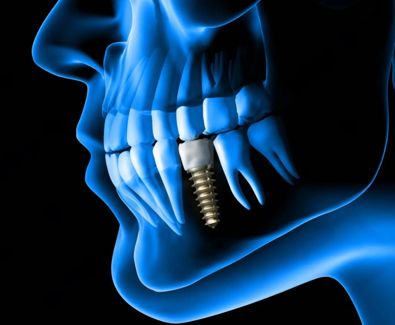 Tipos de implantes dentales – guía para elegir el adecuado