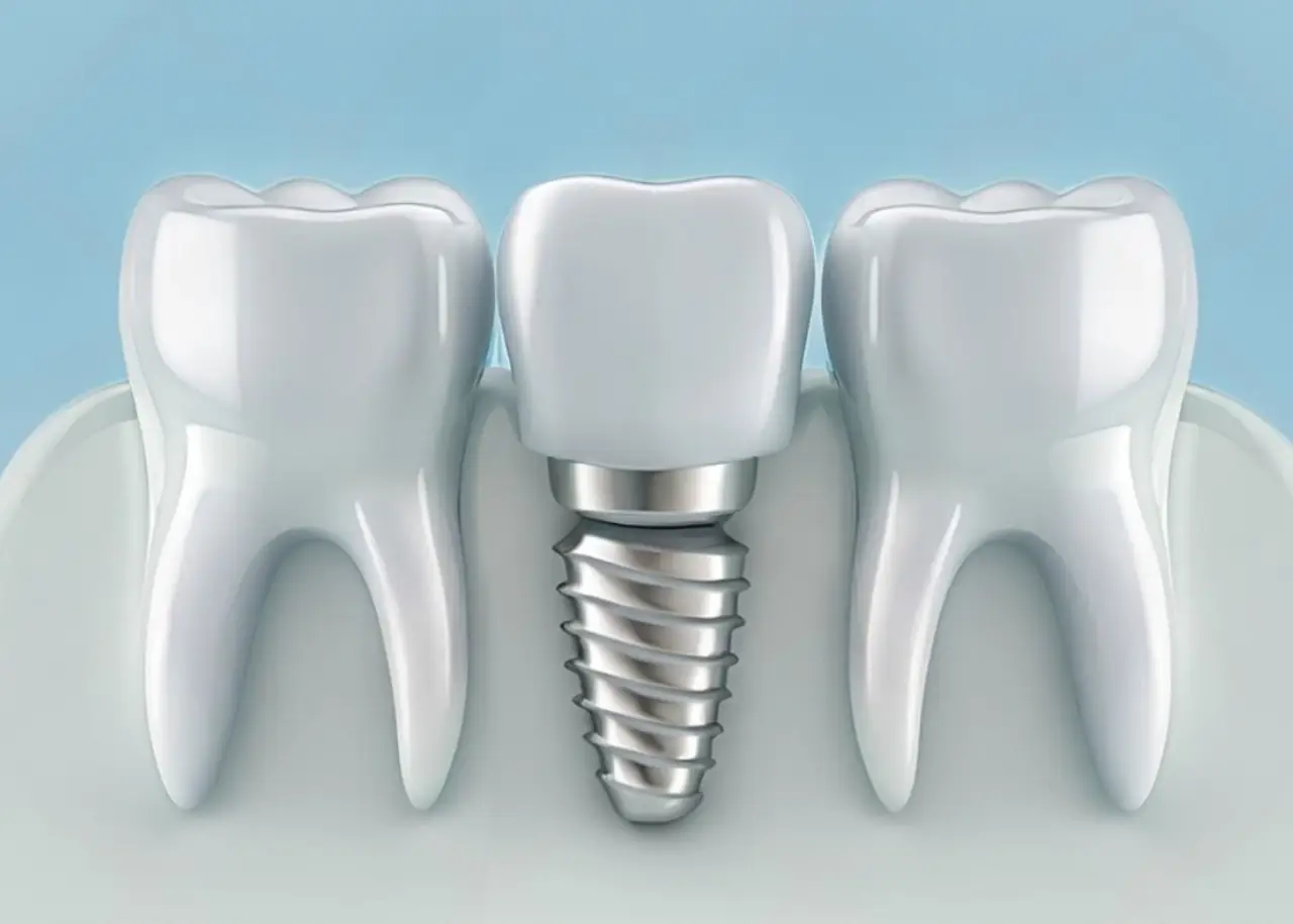 Implantes dentales de carga inmediata