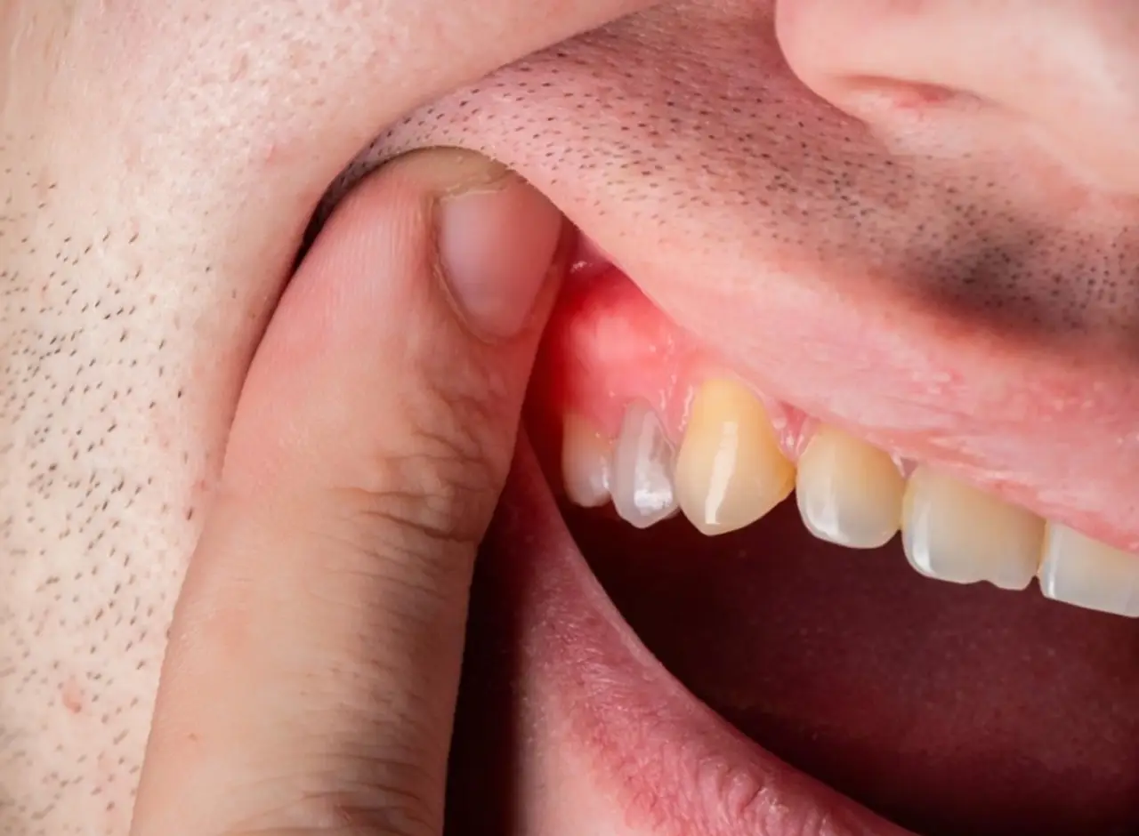 What to Do If You Get a Dental Abscess?