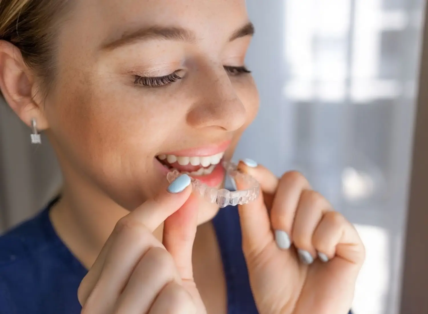 Duration of Invisible Orthodontic Treatment