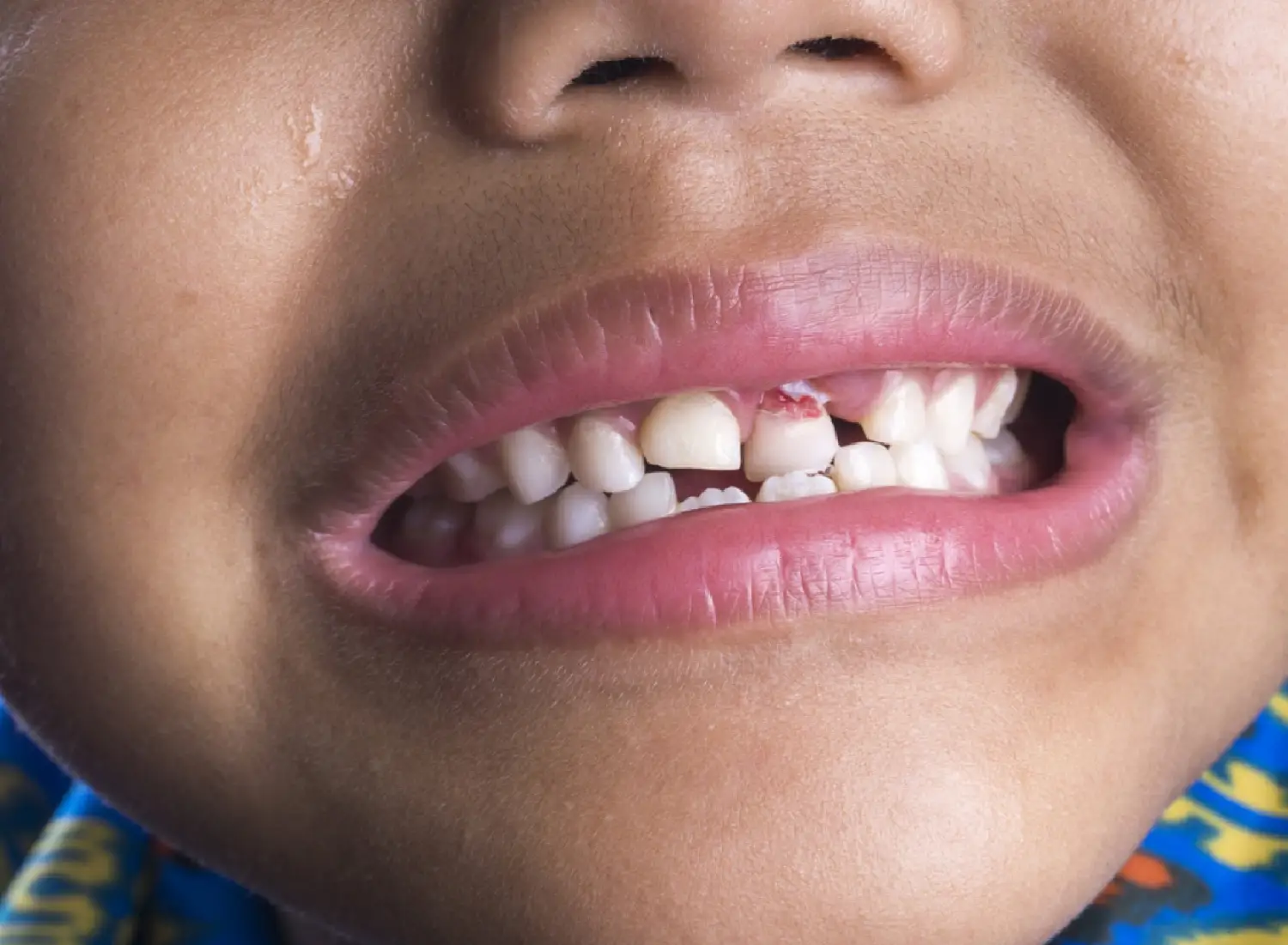 ¿Qué hacer si a un niño se le rompe un diente?