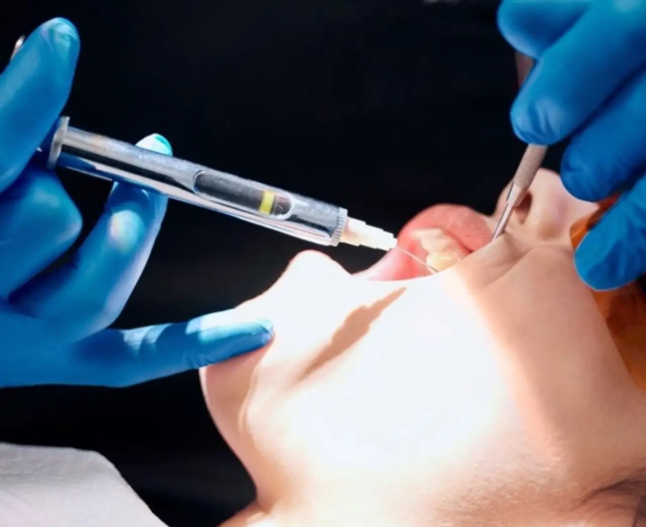 Cómo hacer que la anestesia del dentista se pase antes