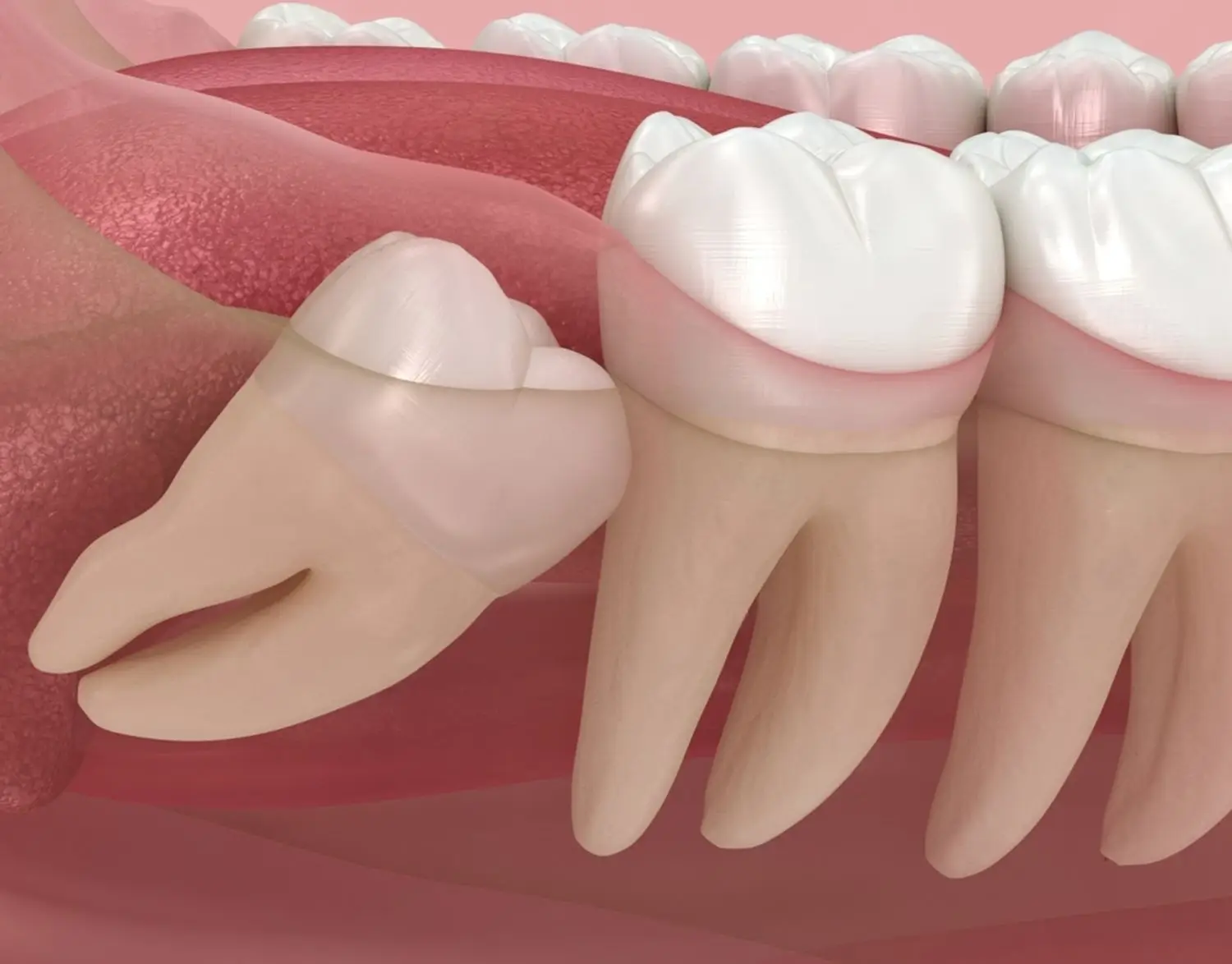 Wisdom Teeth Removal in Palma de Mallorca