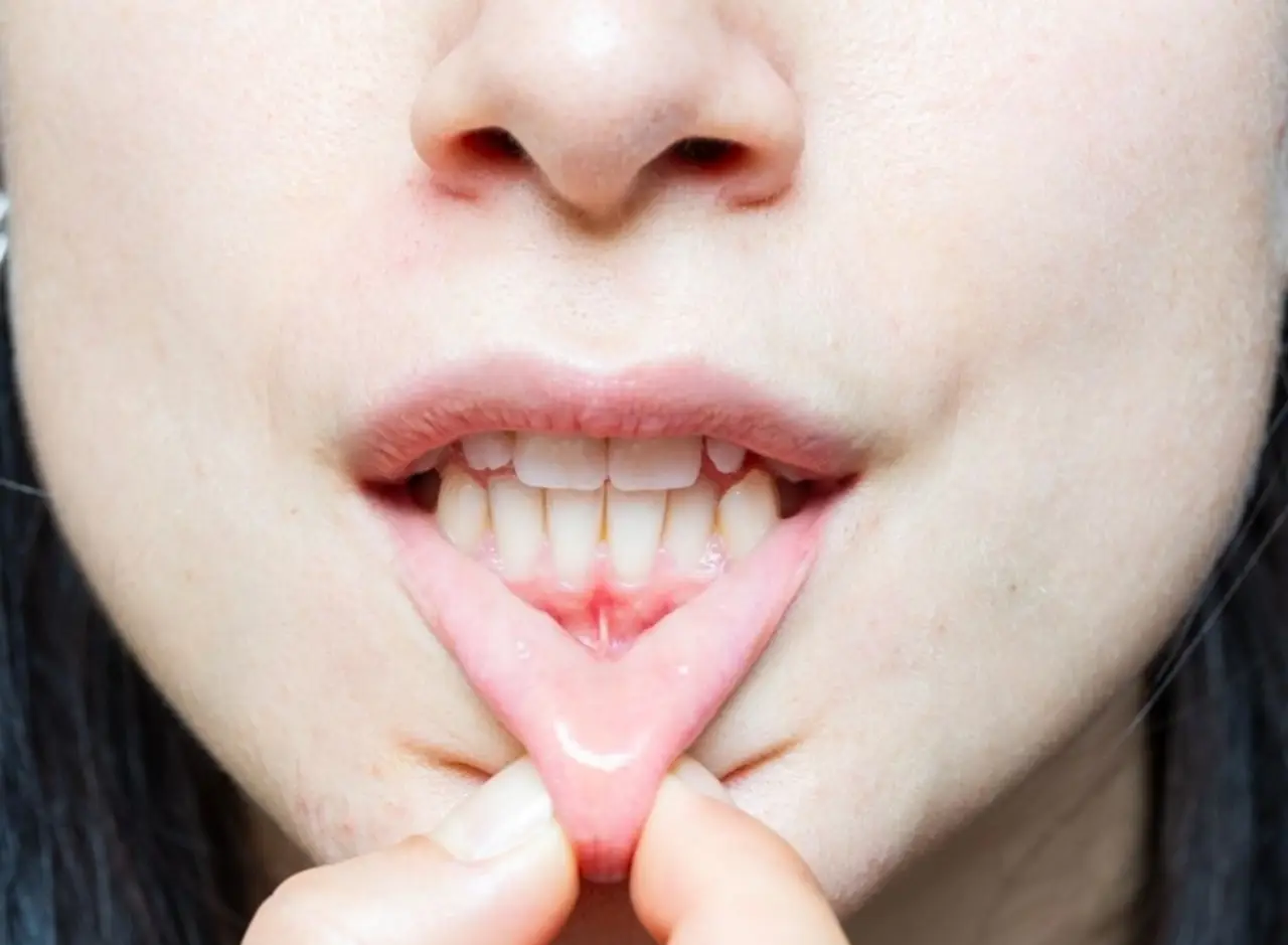 What is gingival recession and how is it treated?