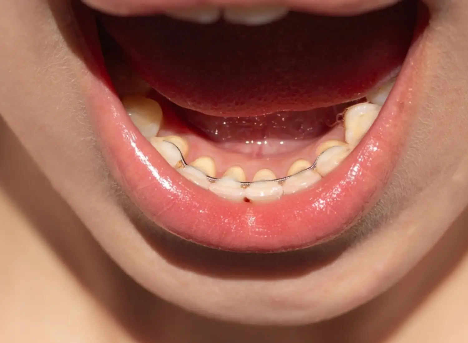 Retainers After Orthodontics